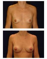 Breast Augmentation