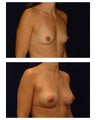 Breast Augmentation