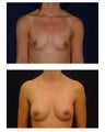 Breast Augmentation