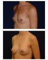 Breast Augmentation