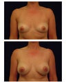 Breast Augmentation