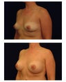 Breast Augmentation