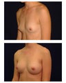 Breast Augmentation