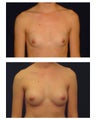 Breast Augmentation