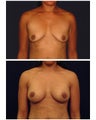 Breast Augmentation