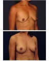 Breast Augmentation