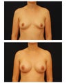 Breast Augmentation