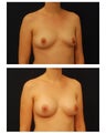 Breast Augmentation