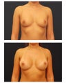 Breast Augmentation
