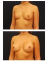Breast Augmentation