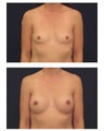 Breast Augmentation