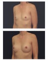 Breast Augmentation