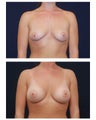 Breast Augmentation