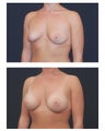 Breast Augmentation