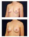Breast Augmentation
