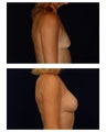 Breast Augmentation
