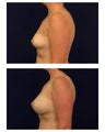 Breast Augmentation