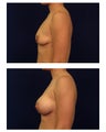 Breast Augmentation