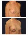 Breast Augmentation