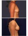 Breast Augmentation