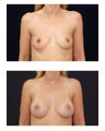 Breast Augmentation