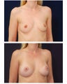 Breast Augmentation