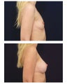 Breast Augmentation
