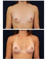 Breast Augmentation