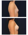 Breast Augmentation