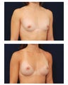 Breast Augmentation