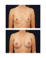 Breast Augmentation