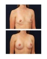 Breast Augmentation