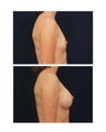 Breast Augmentation