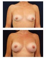 Breast Augmentation