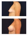 Breast Augmentation