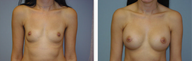Breast augmentation with breast implants