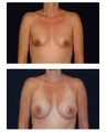Breast Augmentation Surgery With Saline Implants