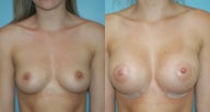 Breast Augmentation with Silicone Implants