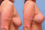 Mastopexy (Breast Lift)