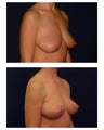 Breast Lift / Mastopexy