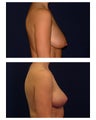 Breast Lift / Mastopexy