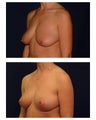 Breast Lift / Mastopexy