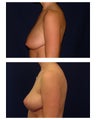 Breast Lift / Mastopexy