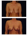 Breast Lift / Mastopexy