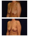 Breast Lift / Mastopexy