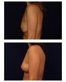 Breast Lift / Mastopexy
