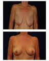 Breast Lift / Mastopexy