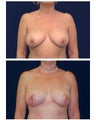 Breast Lift / Mastopexy