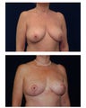 Breast Lift / Mastopexy