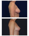 Breast Lift / Mastopexy